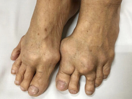 Bệnh Gout là gì? Tất cả những thông tin về bệnh Gout