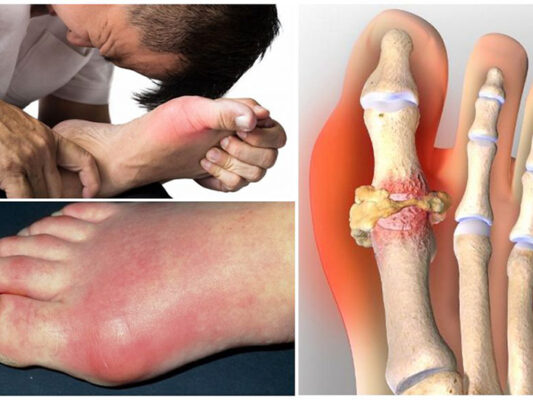 Dấu hiệu nhận biết các giai đoạn của bệnh Gout phổ biến?