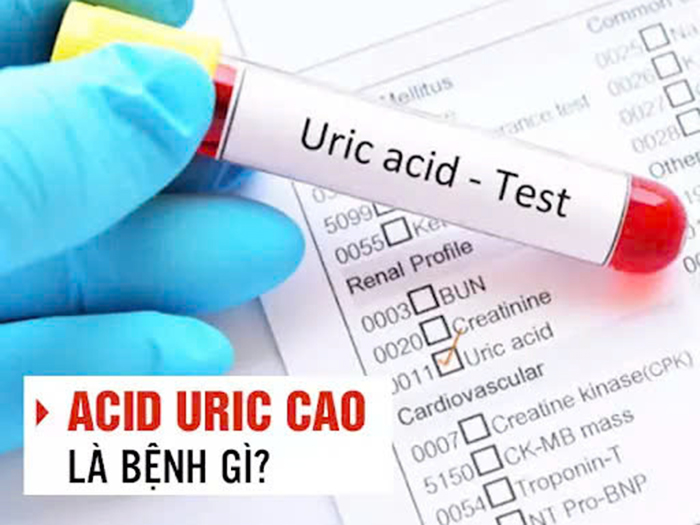 Chỉ số Acid Uric tăng cao bao nhiêu thì bị Gout?