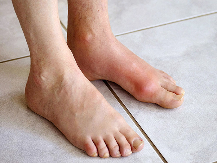 Người Bị Gout Không Nên Ăn Trái Cây Gì Tránh Tăng Axit Uric?