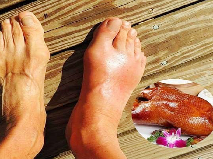 Có nên cho người bị bệnh Gout ăn thịt Vịt không?