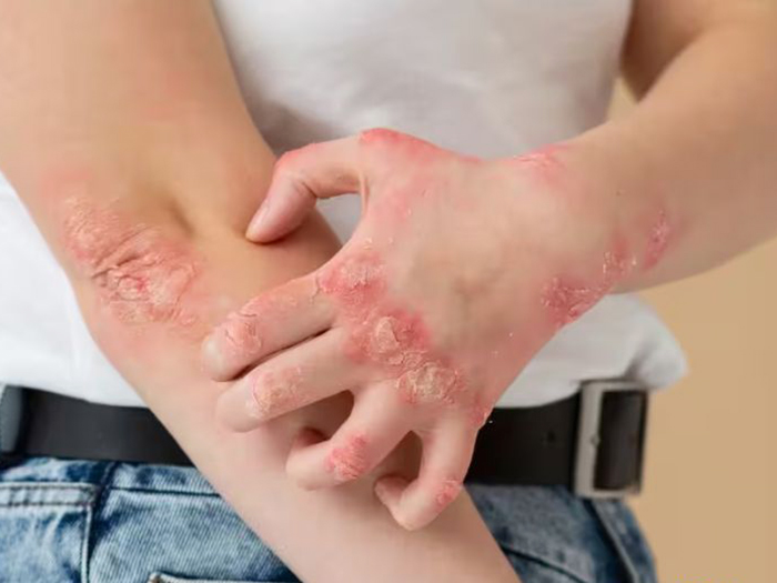 Những dấu hiệu cảnh báo bạn bị bệnh tiểu đường?