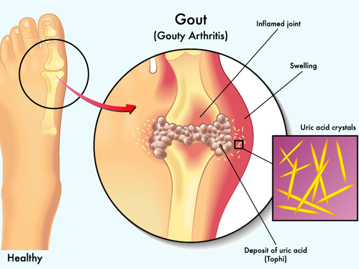 Axit uric tăng cao những bộ phận cơ thể nào sẽ bị ảnh hưởng?
