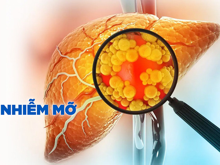 Đánh bay gan nhiễm mỡ nhờ 8 loại thức uống tự nhiên này