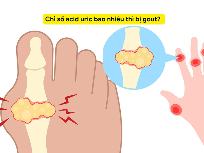 Mách bạn 3 loại quả bí nên ăn mỗi ngày giúp giảm Axit Uric trong máu