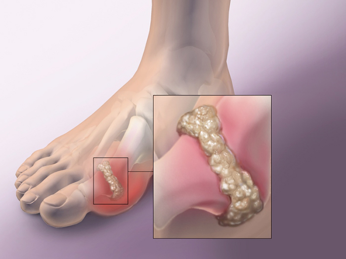 Mách bạn 5 loại thảo dược giúp hạ Axit Uric hiệu quả an toàn