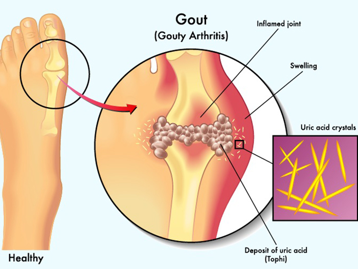 6 loại trái cây giàu vitamin giúp ngăn axit uric tăng cao khi ăn mỗi ngày