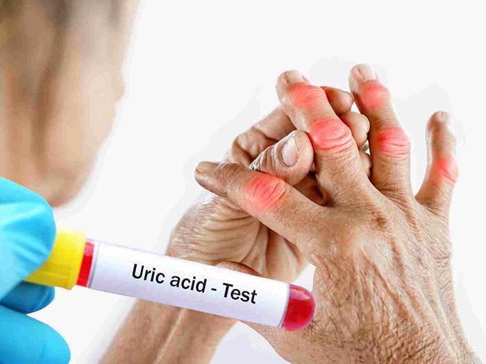 Những nguy cơ khi Acid Uric tăng cao trong mùa hè nắng nóng