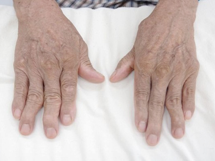 Bệnh thấp khớp là gì? Những cách điều trị bệnh thấp khớp hiện nay