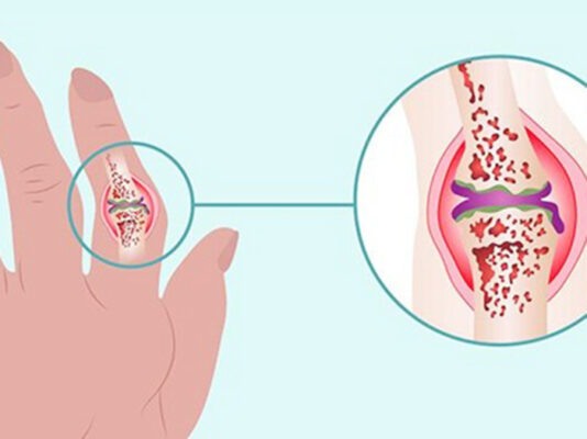 Nguyên nhân, triệu chứng, cách điều trị khô khớp ngón tay hiệu quả