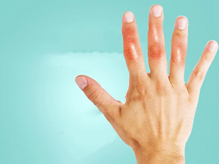 Nguyên nhân, triệu chứng, cách điều trị khô khớp ngón tay hiệu quả