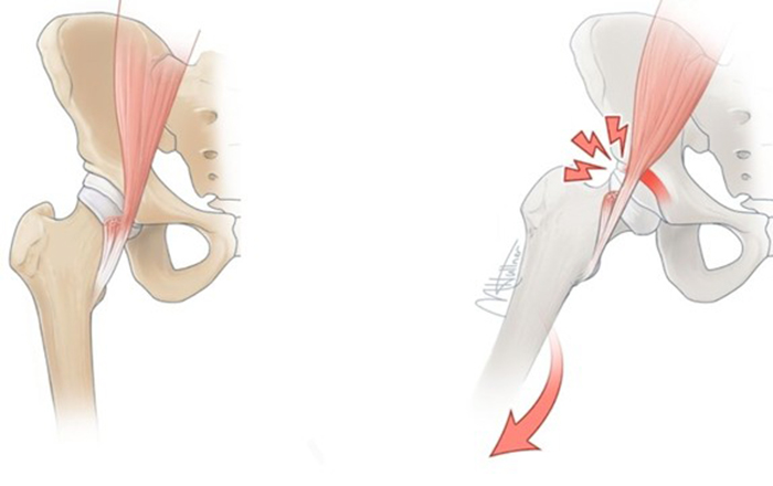 Khớp kêu lục cục có sao không? Nguyên nhân và cách khắc phục