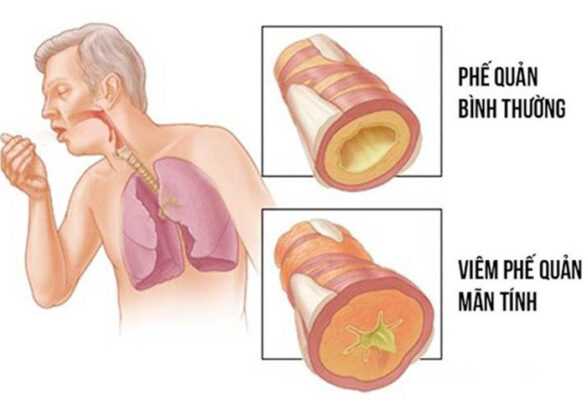 Sự thật về viêm phế quản mạn tính: Có chữa dứt điểm được không?