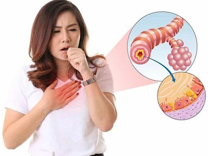 Sự thật về viêm phế quản mạn tính: Có chữa dứt điểm được không?