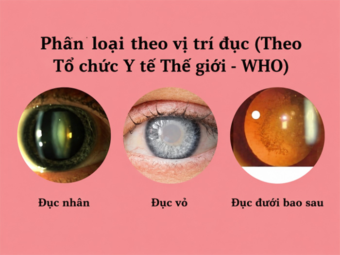 Đục thủy tinh thể ở người già là gì? Nguyên nhân & cách điều trị