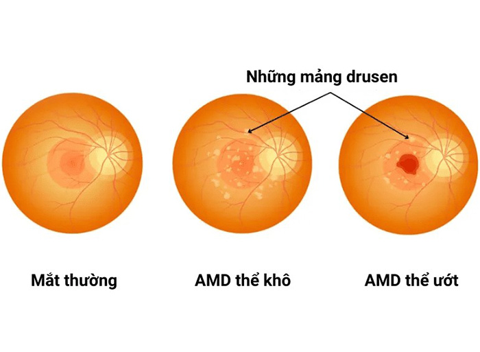 Người già thường mắc bệnh gì về mắt? Những thông tin cần biết