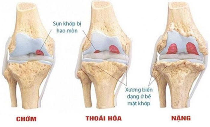 Những dấu hiệu sụn khớp đang xuống cấp bạn cần lưu ý