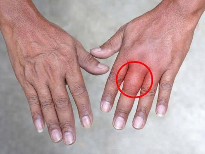 Những dấu hiệu sụn khớp đang xuống cấp bạn cần lưu ý